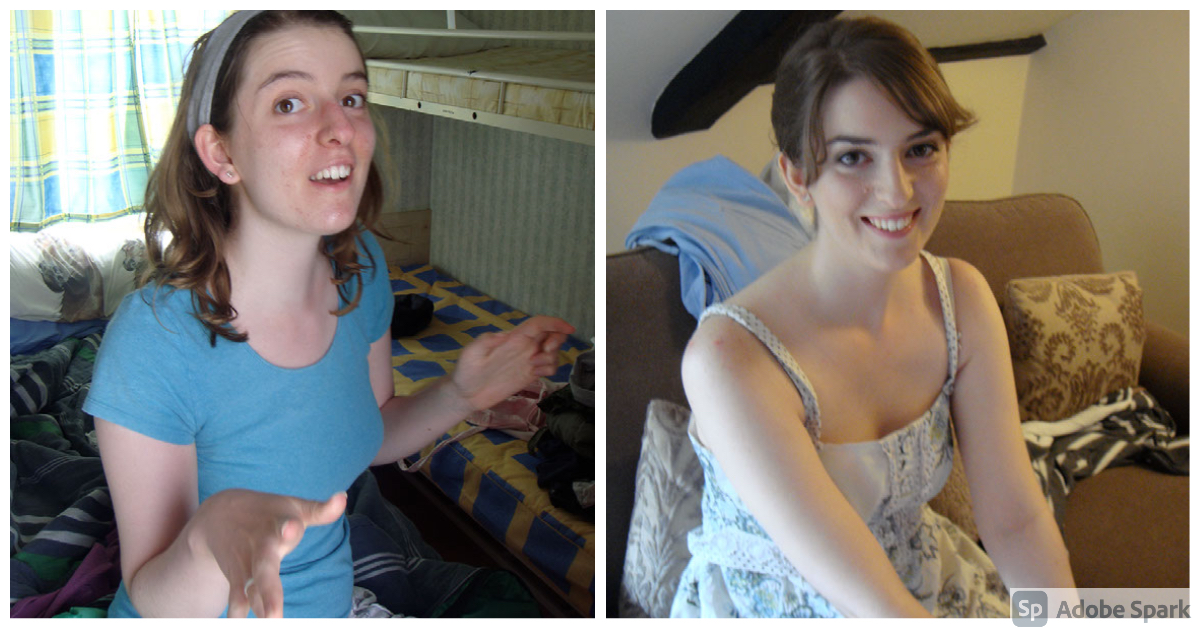 Coping with Facial&nbsp;Angiofibromas